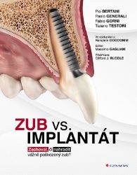 Zub vs. implantát Zub vs. implantát