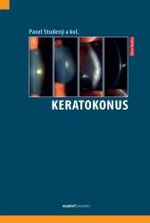 Keratokonus Keratokonus