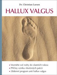 Hallux valgus Hallux valgus