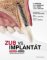 Zub vs. implantát Zub vs. implantát
